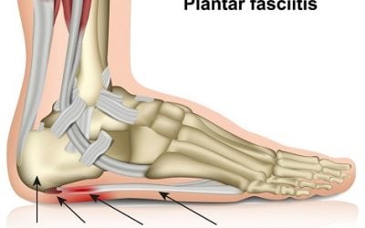 Plantar Fasciitis (Heel Pain)