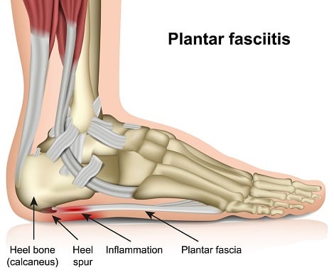 Plantar Fasciitis (Heel Pain)